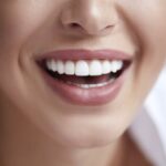 The Benefits of Veneers