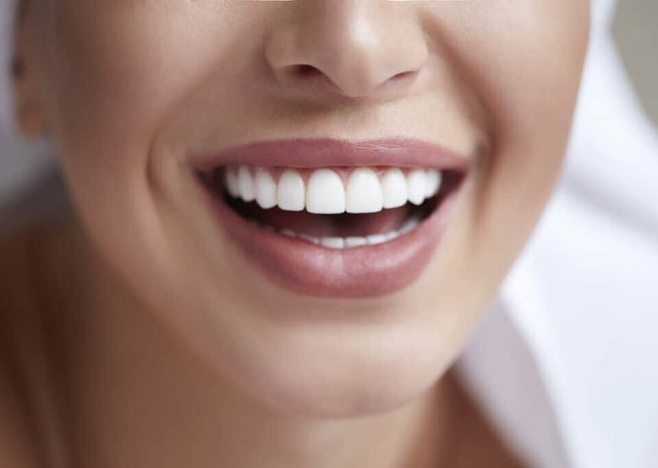 The Benefits of Veneers