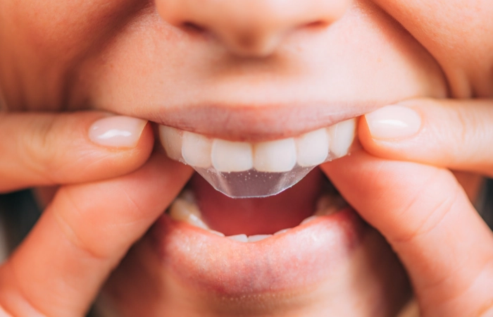 The Pros and Cons of At-Home Teeth Whitening Kits