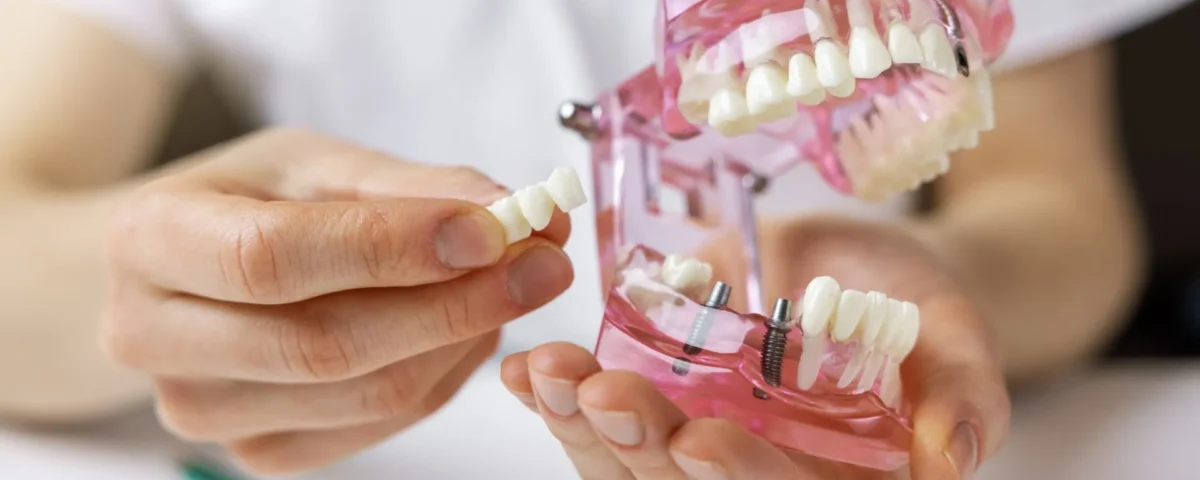 The Role of Dental Implants in Restoring Confidence