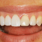 The Role of Veneers in Enhancing Dental Aesthetics