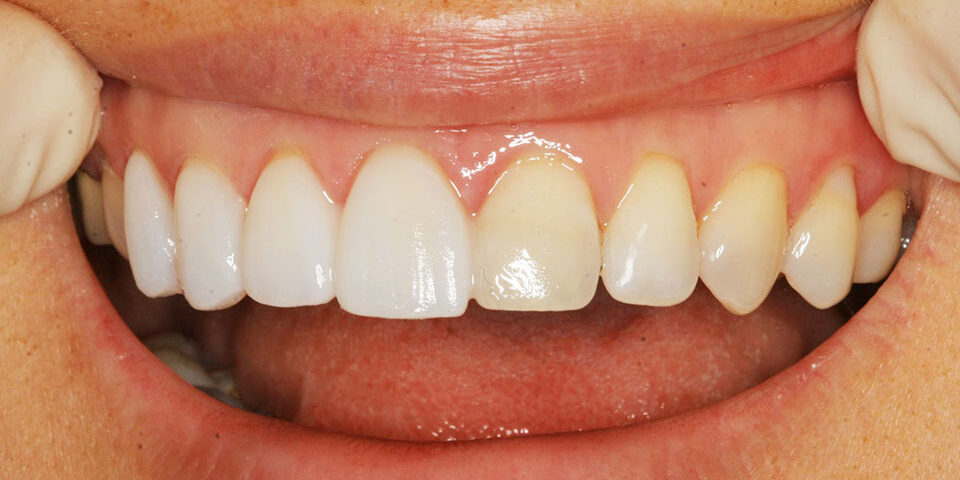 The Role of Veneers in Enhancing Dental Aesthetics