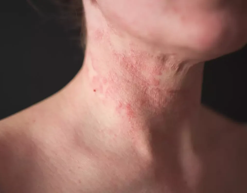 Causes and Treatments for Dermatitis