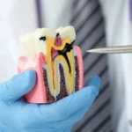 The Long-term Benefits of Timely Root Canal Treatments