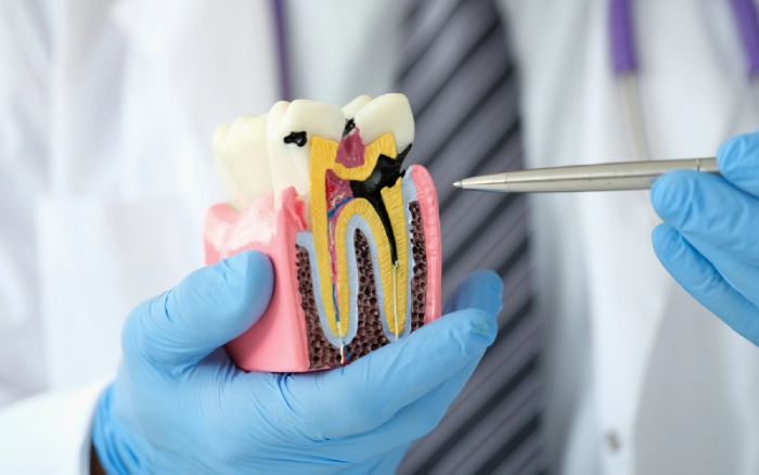 The Long-term Benefits of Timely Root Canal Treatments