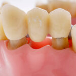 Understanding the Benefits of Crowns and Bridges