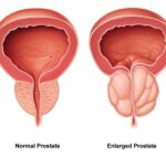 Understanding the Different Types of Treatments for Enlarged Prostate