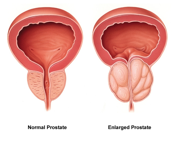 Understanding the Different Types of Treatments for Enlarged Prostate