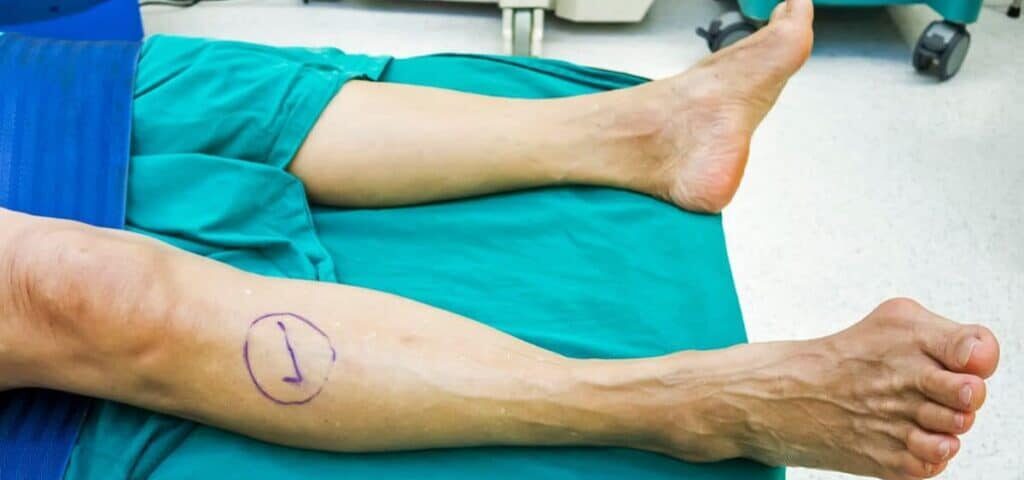 What To Know About Surgical Options for Bunions