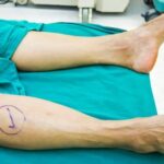 What To Know About Surgical Options for Bunions