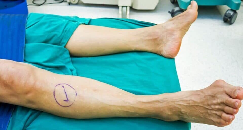 What To Know About Surgical Options for Bunions