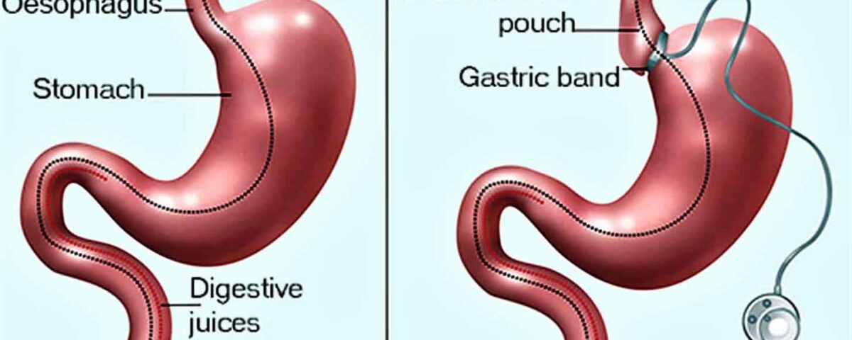 Overcoming Common Challenges After Gallbladder Removal Surgery