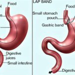 Overcoming Common Challenges After Gallbladder Removal Surgery