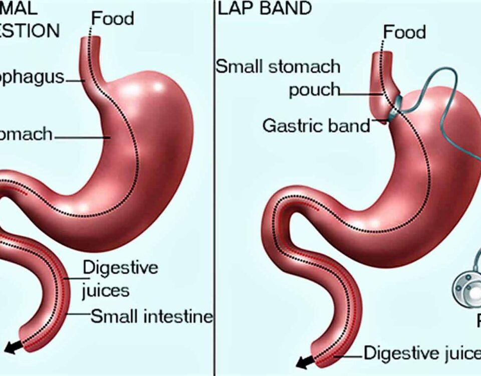 Overcoming Common Challenges After Gallbladder Removal Surgery