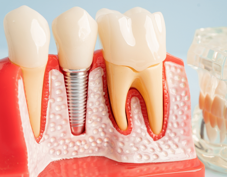 Debunking Myths About Tooth Extractions