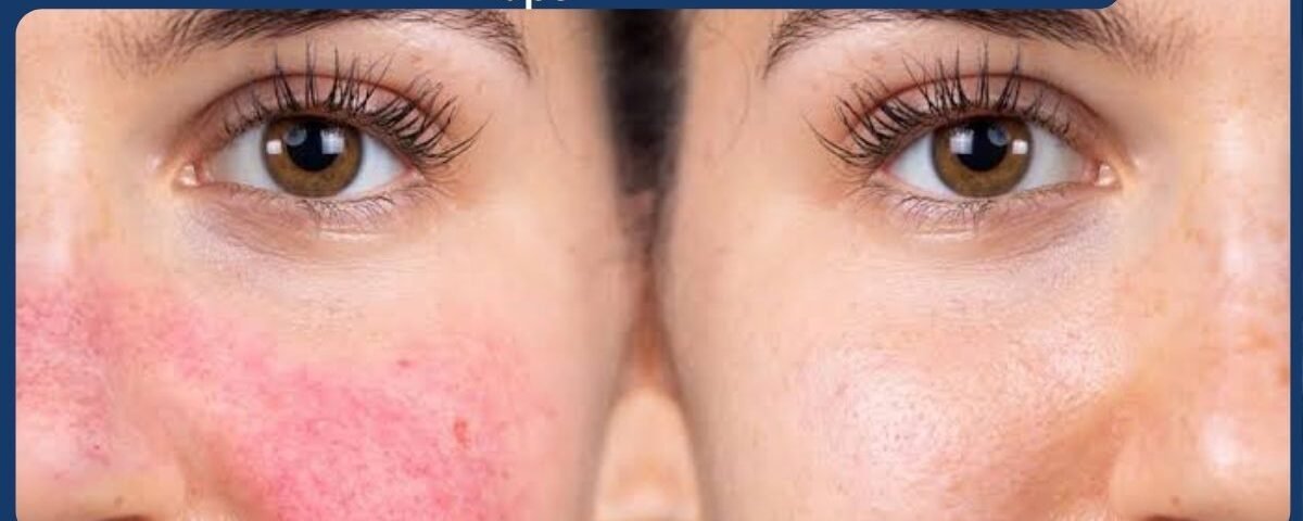 How Do You Calm Type 2 Rosacea and Reduce Flare-Ups
